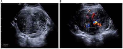 Case report: Uterine leiomyoma with fumarate hydratase deficiency